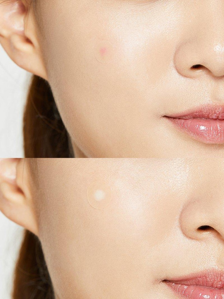 Cosrx Acne Pimple Master Patch — view 2