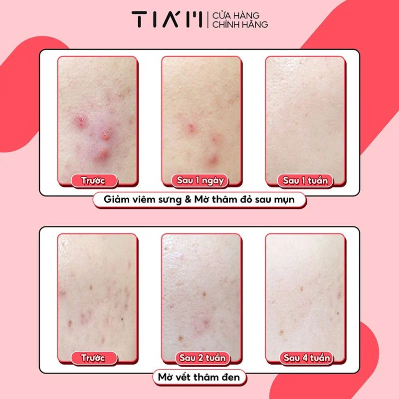 Tiam Ac Fighting Spot Rx Cream 30g — view 3
