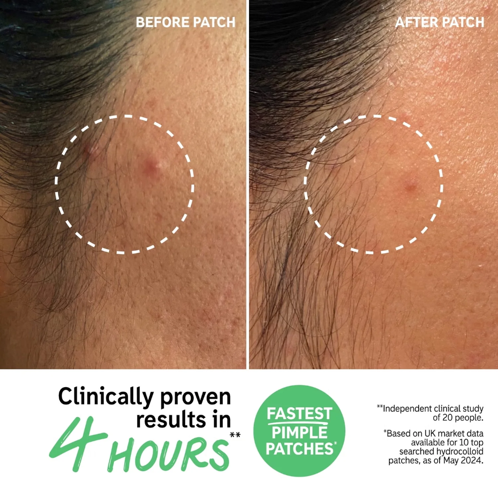 The Inkey List Pimple Patches — view 2
